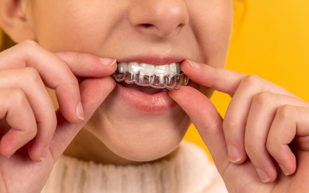 Orthodontic patient placing a clear dental aligner